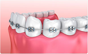Braces