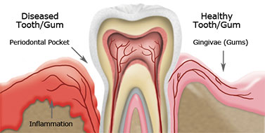 Gum Diseases